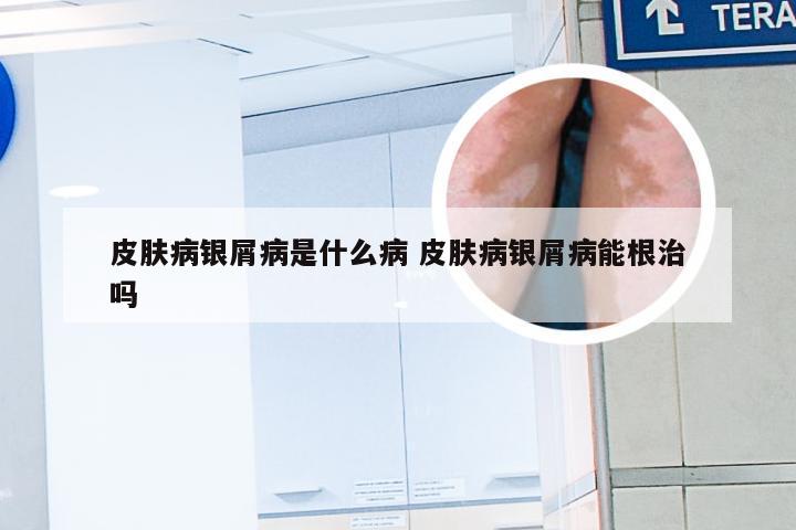 皮肤病银屑病是什么病 皮肤病银屑病能根治吗