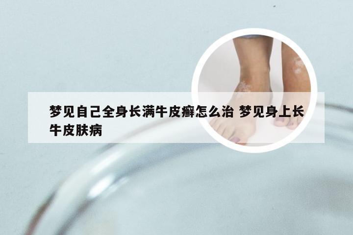 梦见自己全身长满牛皮癣怎么治 梦见身上长牛皮肤病