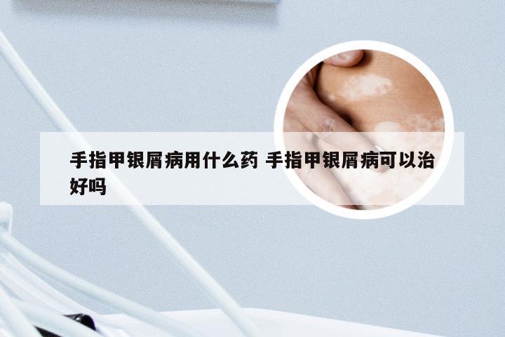 手指甲银屑病用什么药 手指甲银屑病可以治好吗
