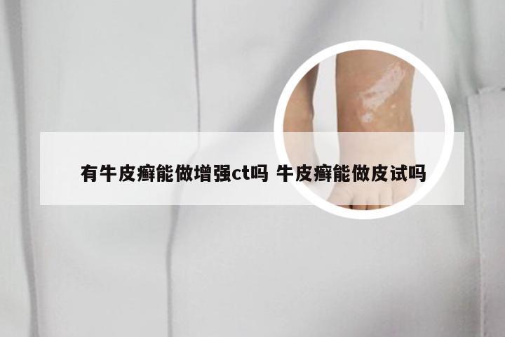 有牛皮癣能做增强ct吗 牛皮癣能做皮试吗
