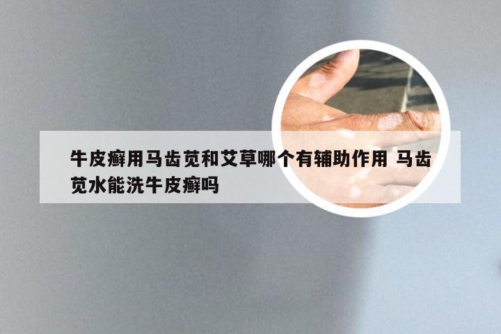 牛皮癣用马齿苋和艾草哪个有辅助作用 马齿苋水能洗牛皮癣吗