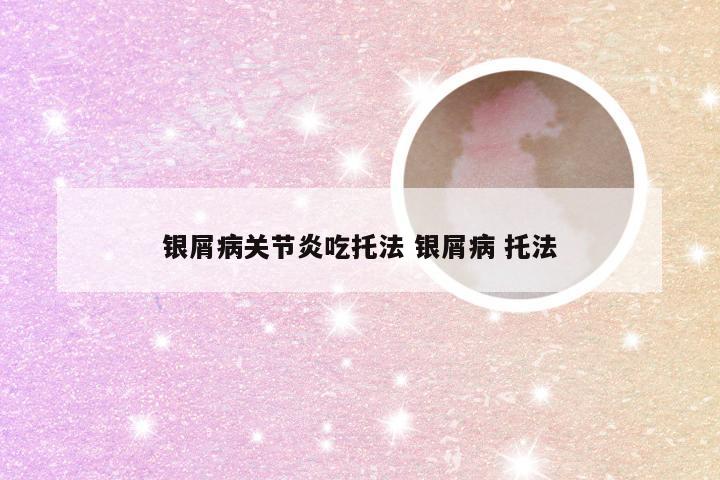银屑病关节炎吃托法 银屑病 托法