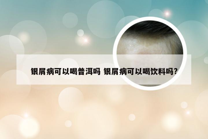 银屑病可以喝普洱吗 银屑病可以喝饮料吗?