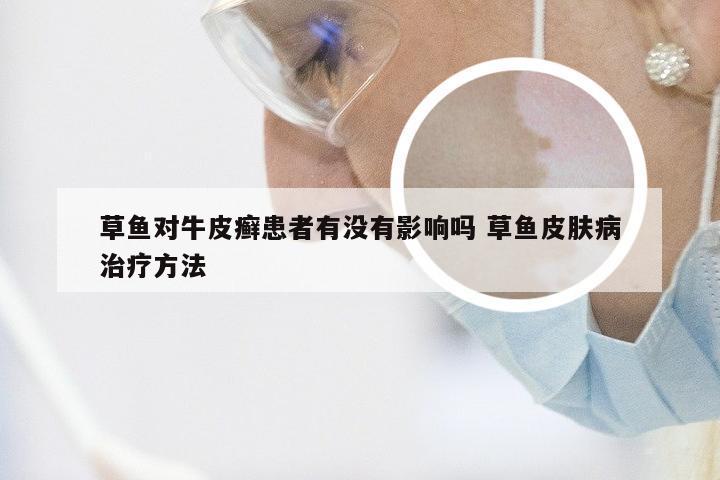 草鱼对牛皮癣患者有没有影响吗 草鱼皮肤病治疗方法