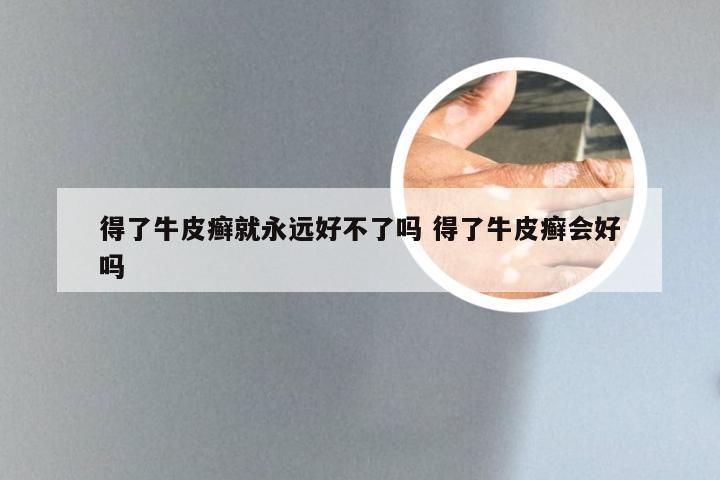 得了牛皮癣就永远好不了吗 得了牛皮癣会好吗
