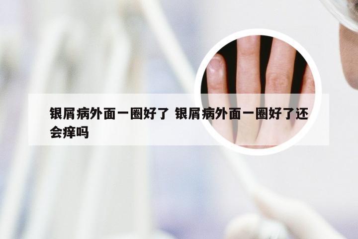 银屑病外面一圈好了 银屑病外面一圈好了还会痒吗
