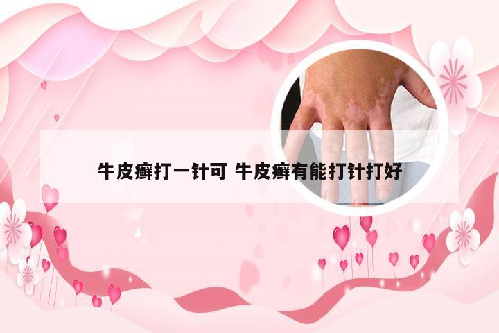牛皮癣打一针可 牛皮癣有能打针打好