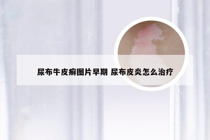 尿布牛皮癣图片早期 尿布皮炎怎么治疗