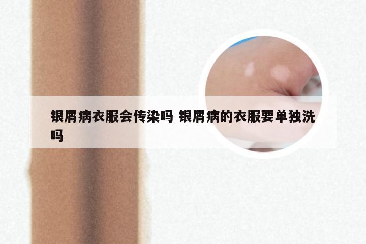 银屑病衣服会传染吗 银屑病的衣服要单独洗吗