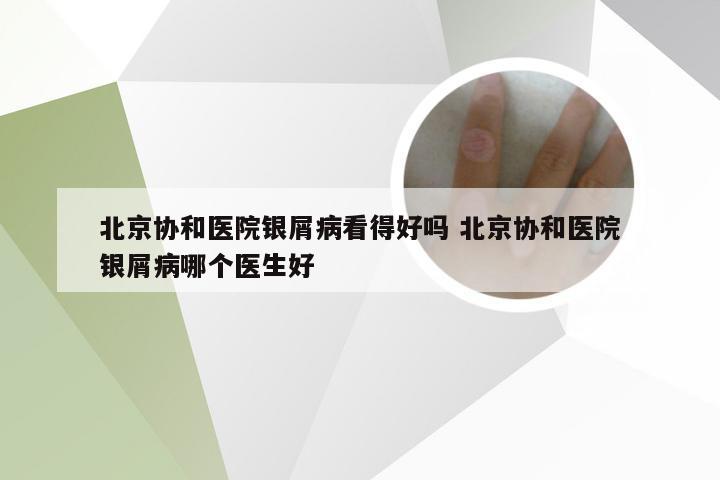 北京协和医院银屑病看得好吗 北京协和医院银屑病哪个医生好