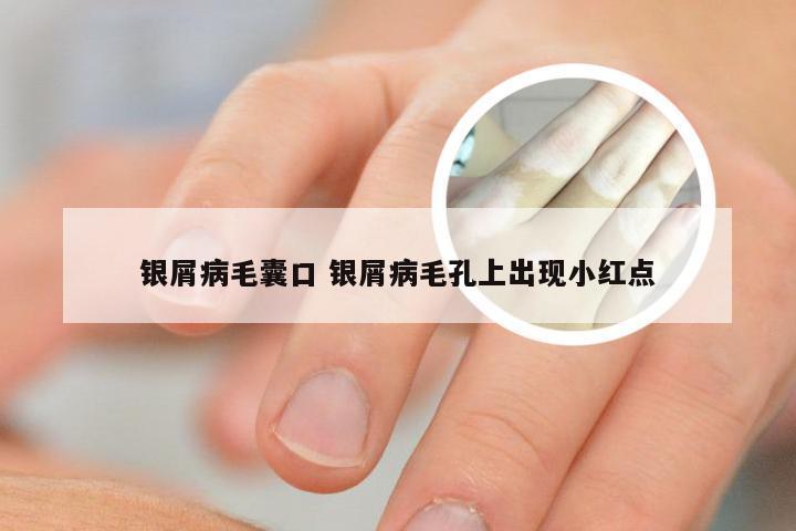 银屑病毛囊口 银屑病毛孔上出现小红点