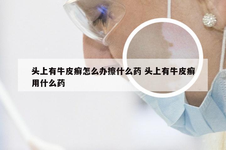 头上有牛皮癣怎么办擦什么药 头上有牛皮癣用什么药