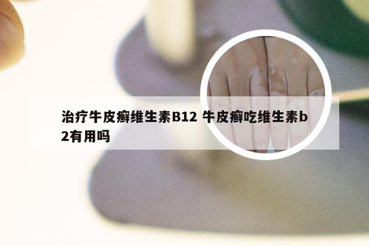 治疗牛皮癣维生素B12 牛皮癣吃维生素b2有用吗
