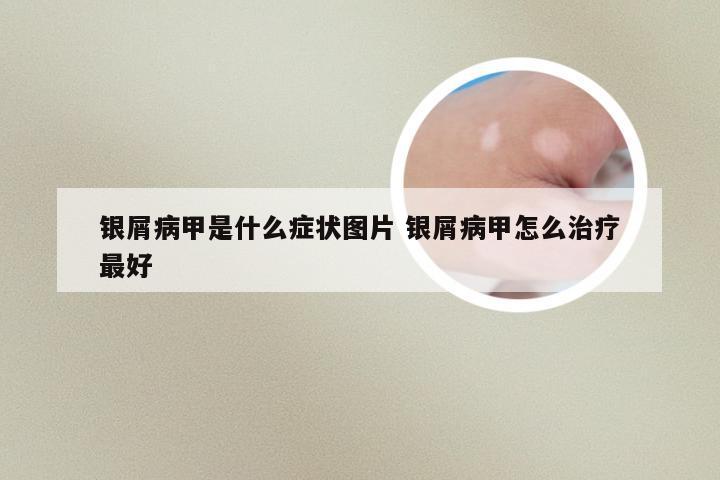 银屑病甲是什么症状图片 银屑病甲怎么治疗最好