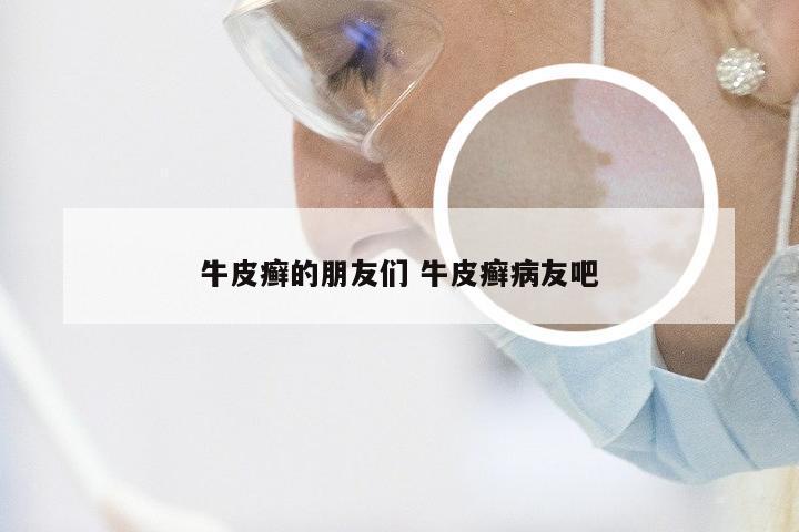 牛皮癣的朋友们 牛皮癣病友吧