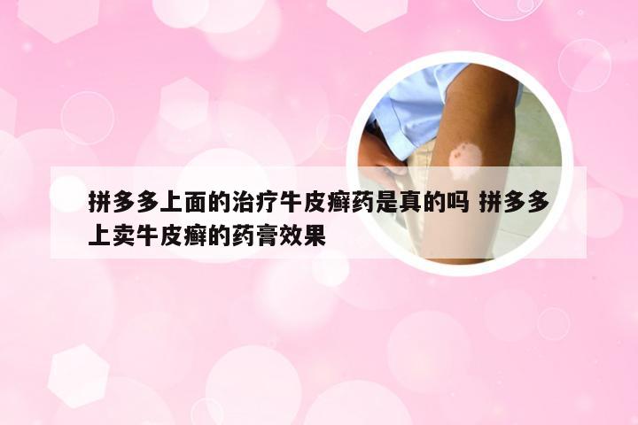 拼多多上面的治疗牛皮癣药是真的吗 拼多多上卖牛皮癣的药膏效果