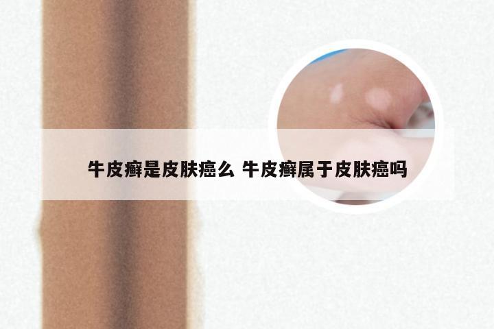 牛皮癣是皮肤癌么 牛皮癣属于皮肤癌吗