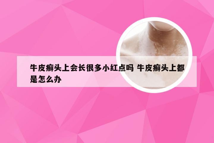 牛皮癣头上会长很多小红点吗 牛皮癣头上都是怎么办