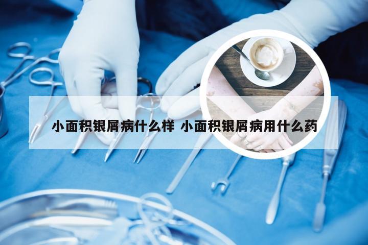 小面积银屑病什么样 小面积银屑病用什么药