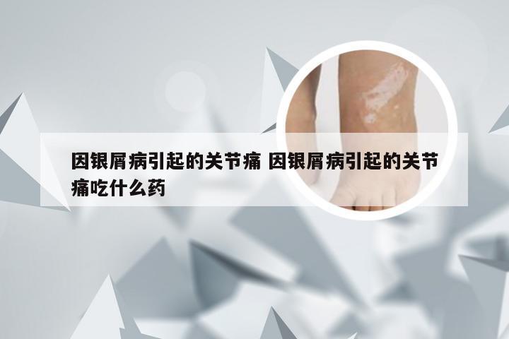 因银屑病引起的关节痛 因银屑病引起的关节痛吃什么药