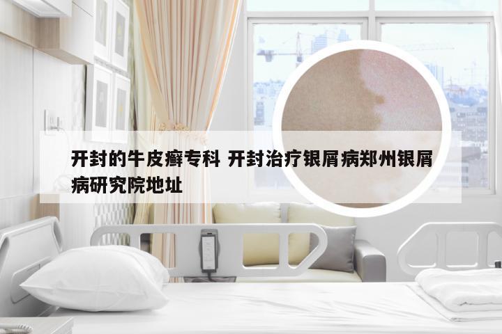 开封的牛皮癣专科 开封治疗银屑病郑州银屑病研究院地址