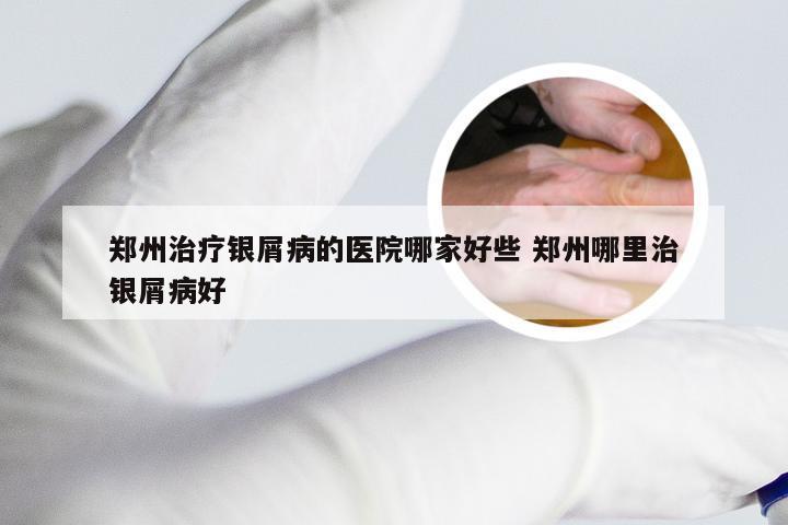 郑州治疗银屑病的医院哪家好些 郑州哪里治银屑病好