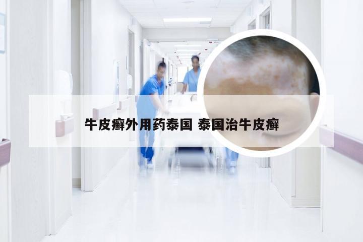 牛皮癣外用药泰国 泰国治牛皮癣