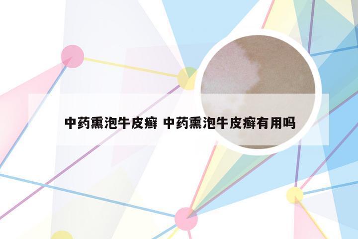 中药熏泡牛皮癣 中药熏泡牛皮癣有用吗