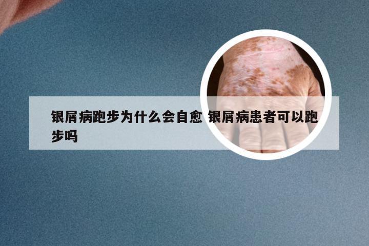银屑病跑步为什么会自愈 银屑病患者可以跑步吗