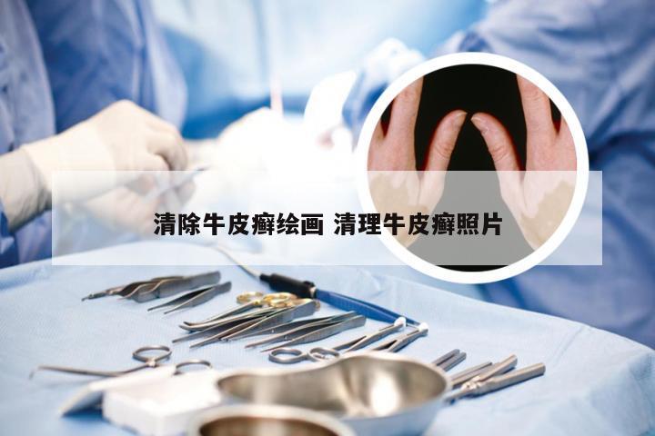 清除牛皮癣绘画 清理牛皮癣照片