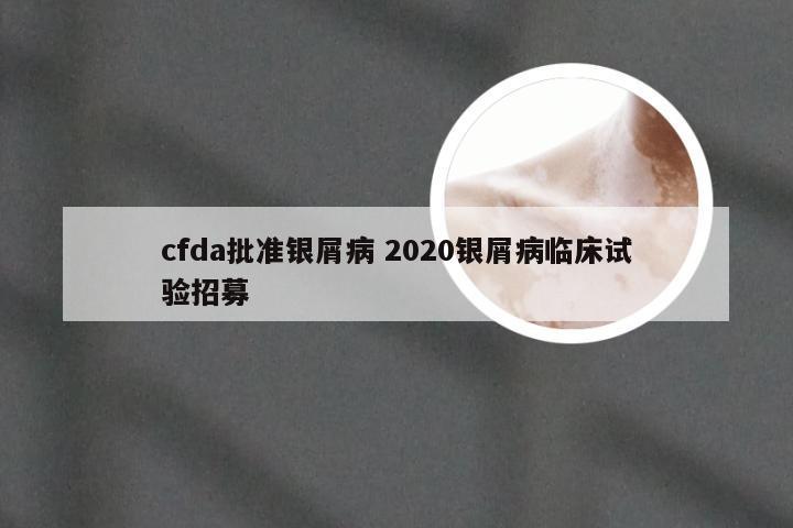 cfda批准银屑病 2020银屑病临床试验招募