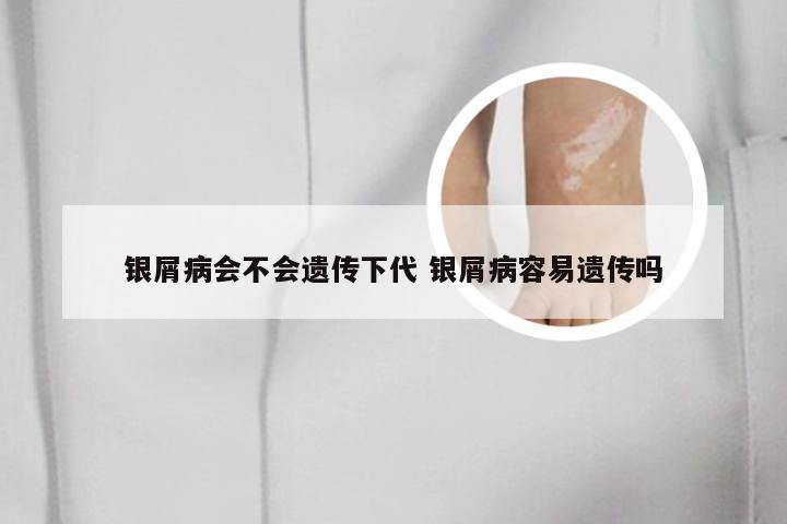 银屑病会不会遗传下代 银屑病容易遗传吗