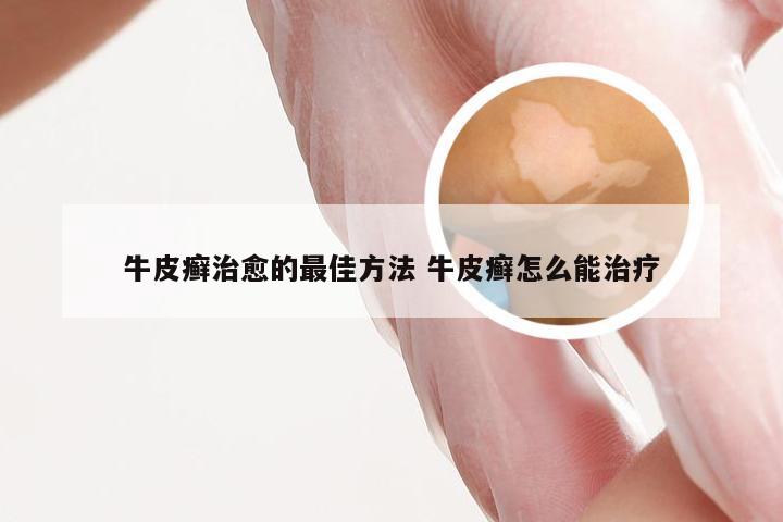 牛皮癣治愈的最佳方法 牛皮癣怎么能治疗