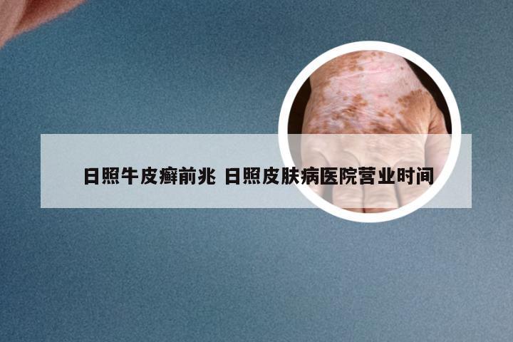 日照牛皮癣前兆 日照皮肤病医院营业时间
