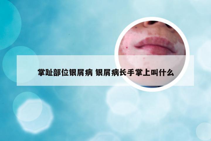 掌趾部位银屑病 银屑病长手掌上叫什么