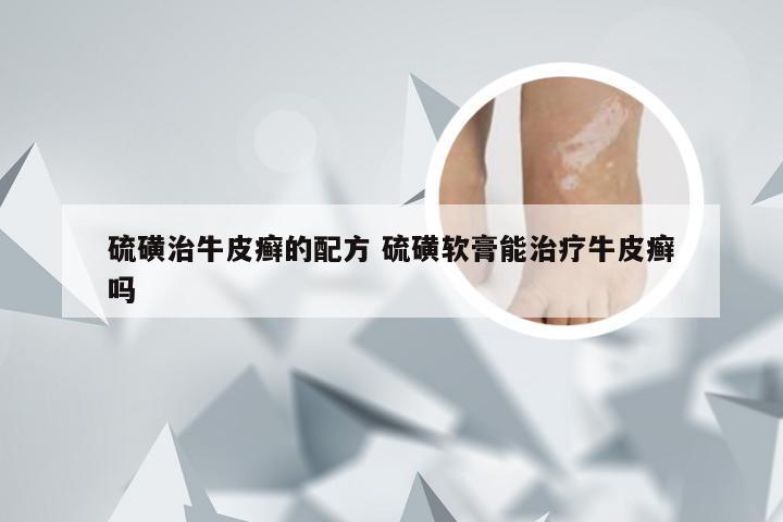 硫磺治牛皮癣的配方 硫磺软膏能治疗牛皮癣吗