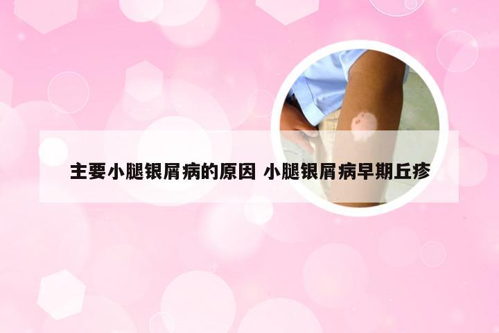 主要小腿银屑病的原因 小腿银屑病早期丘疹