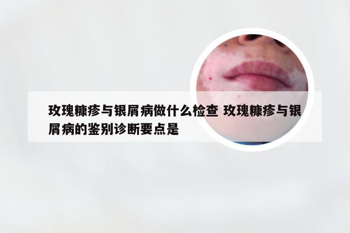 玫瑰糠疹与银屑病做什么检查 玫瑰糠疹与银屑病的鉴别诊断要点是