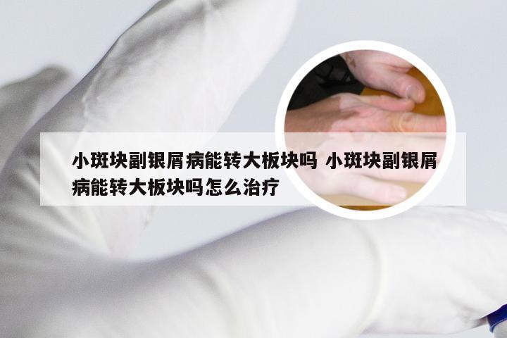小斑块副银屑病能转大板块吗 小斑块副银屑病能转大板块吗怎么治疗