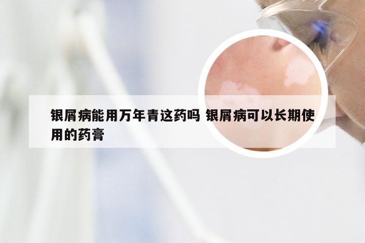 银屑病能用万年青这药吗 银屑病可以长期使用的药膏
