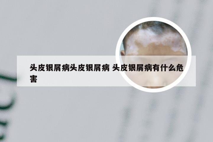 头皮银屑病头皮银屑病 头皮银屑病有什么危害