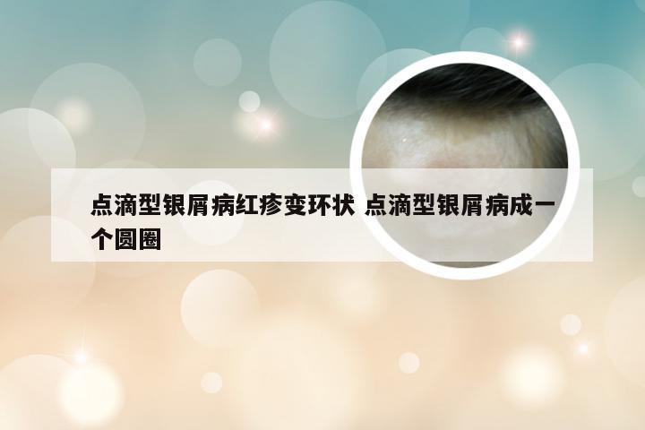 点滴型银屑病红疹变环状 点滴型银屑病成一个圆圈