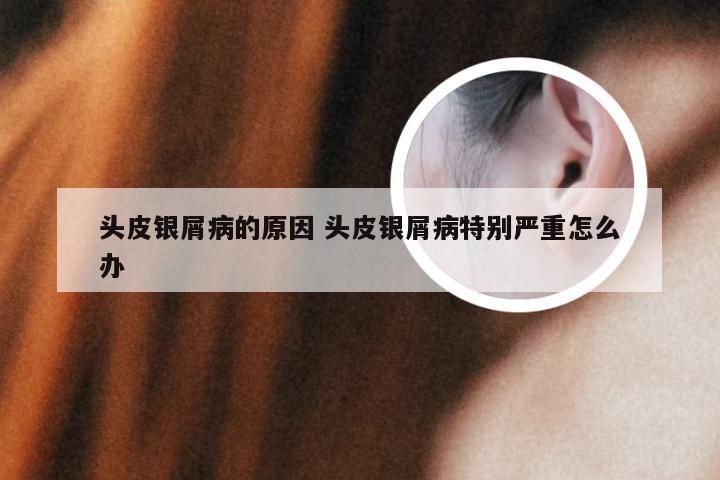 头皮银屑病的原因 头皮银屑病特别严重怎么办