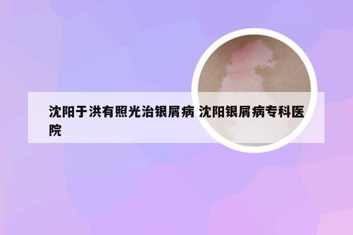 沈阳于洪有照光治银屑病 沈阳银屑病专科医院