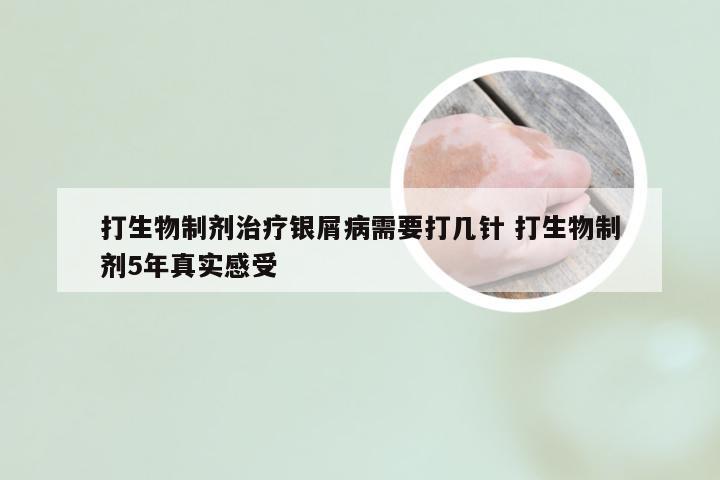 打生物制剂治疗银屑病需要打几针 打生物制剂5年真实感受