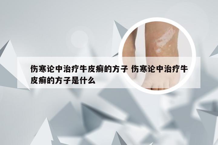 伤寒论中治疗牛皮癣的方子 伤寒论中治疗牛皮癣的方子是什么