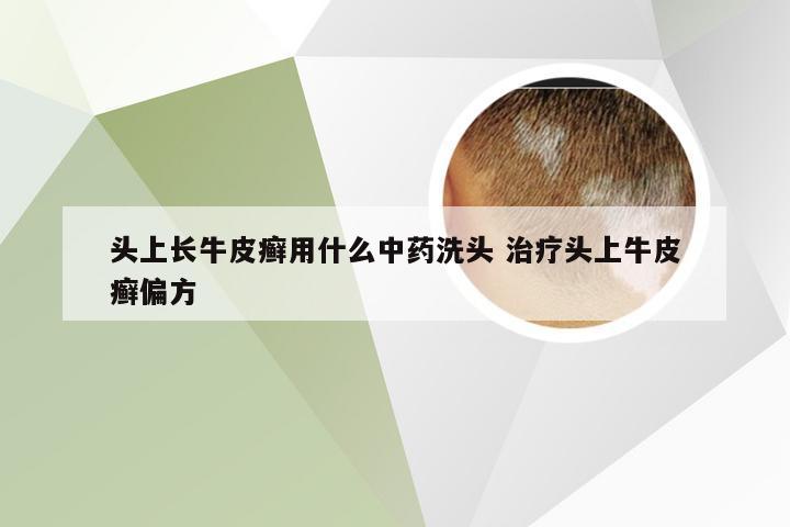 头上长牛皮癣用什么中药洗头 治疗头上牛皮癣偏方