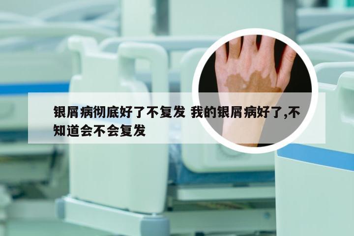 银屑病彻底好了不复发 我的银屑病好了,不知道会不会复发