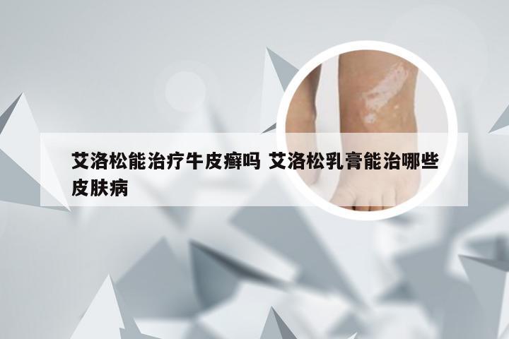 艾洛松能治疗牛皮癣吗 艾洛松乳膏能治哪些皮肤病
