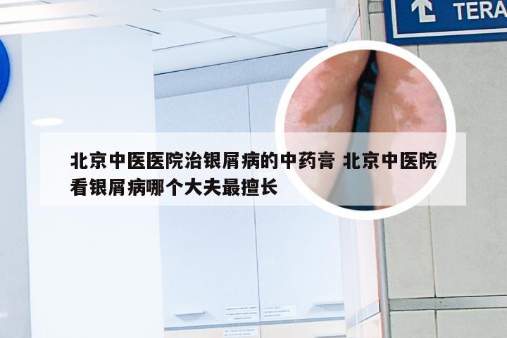 北京中医医院治银屑病的中药膏 北京中医院看银屑病哪个大夫最擅长